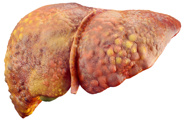 Cirrhosis